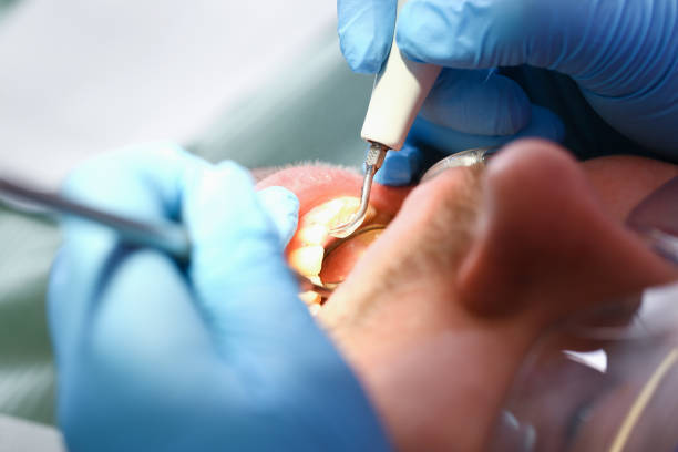 Best Emergency Root Canal Therapy in Titusville, FL